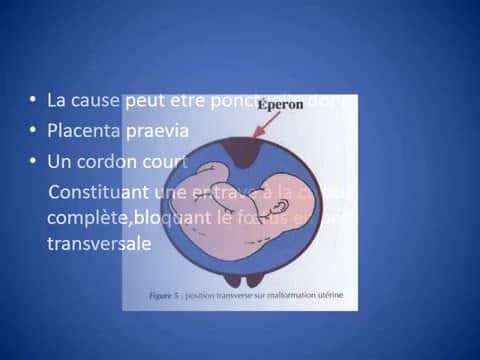 Bébé en transverse : méthodes pour le retourner facilement